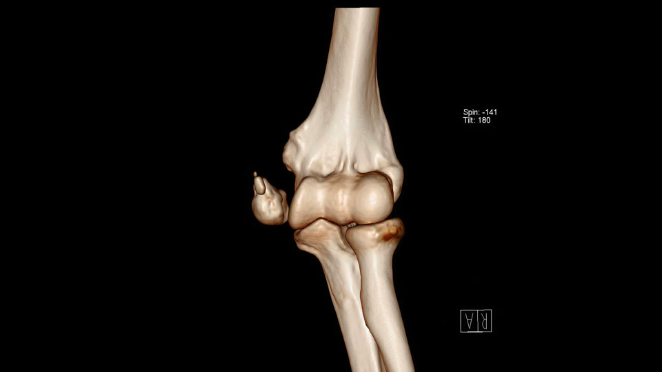 Elbow fractures
