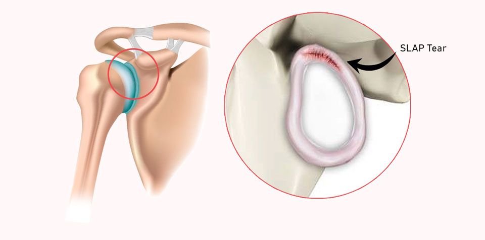 SLAP tear (Superior Labrum Anterior and Posterior)