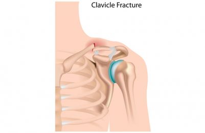 Fractures of Shoulder