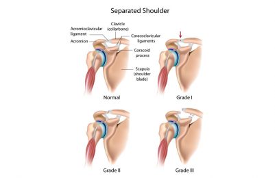 Shoulder joint injuries
