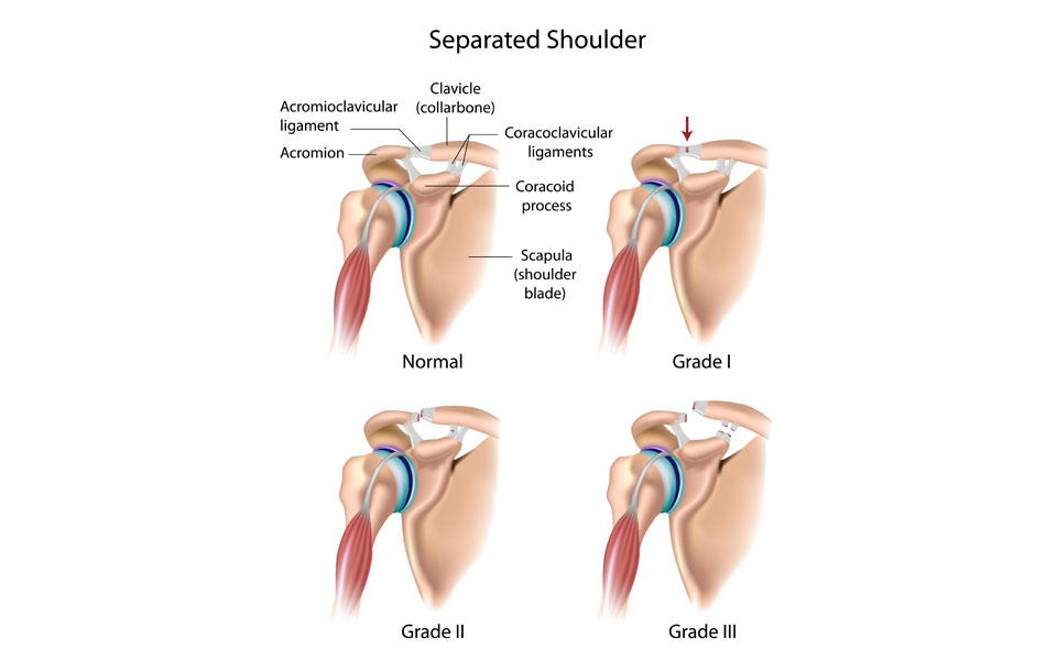 Shoulder joint injuries acromioclavicular (AC) and sternoclavicular (SC)