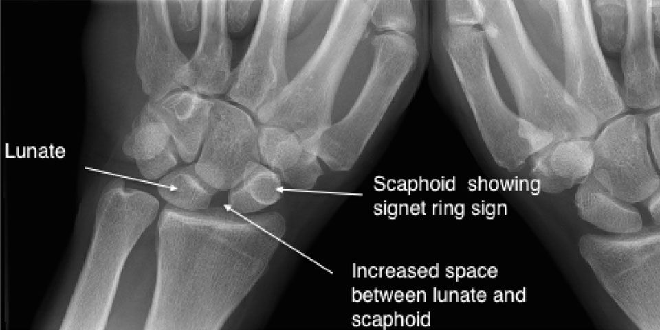 Scapholunate (SL) Ligament
