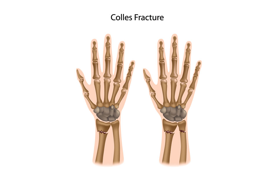 Distal Radius Fractures (Broken Wrist)