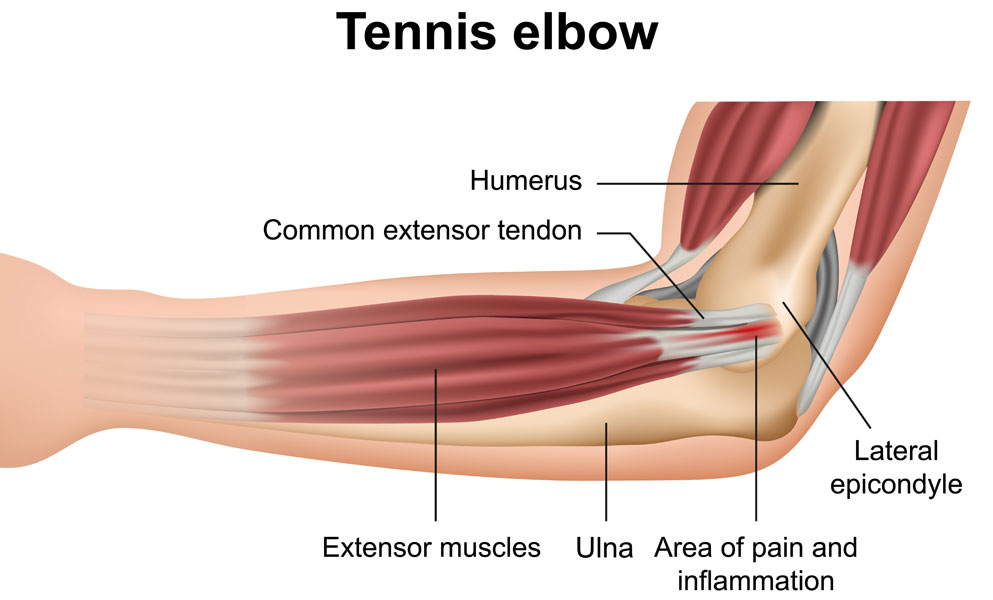 Tendinopathy (medial, lateral elbow)