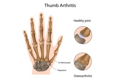 Thumb arthritis