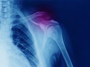 AC Joint Injury Causes, Symptoms & Treatment