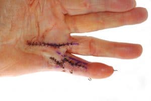 Dupuytren’s Disease Hand Therapy