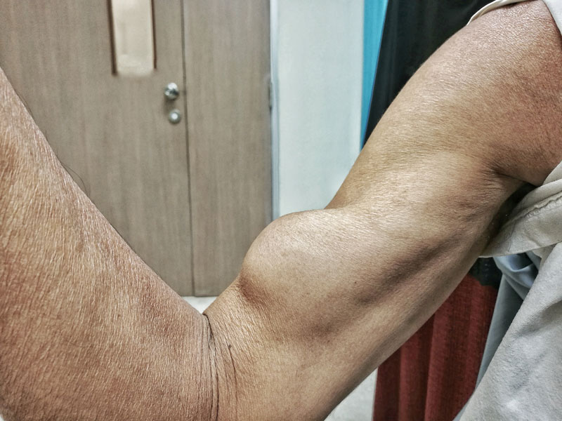 Distal Biceps Tendon Tear