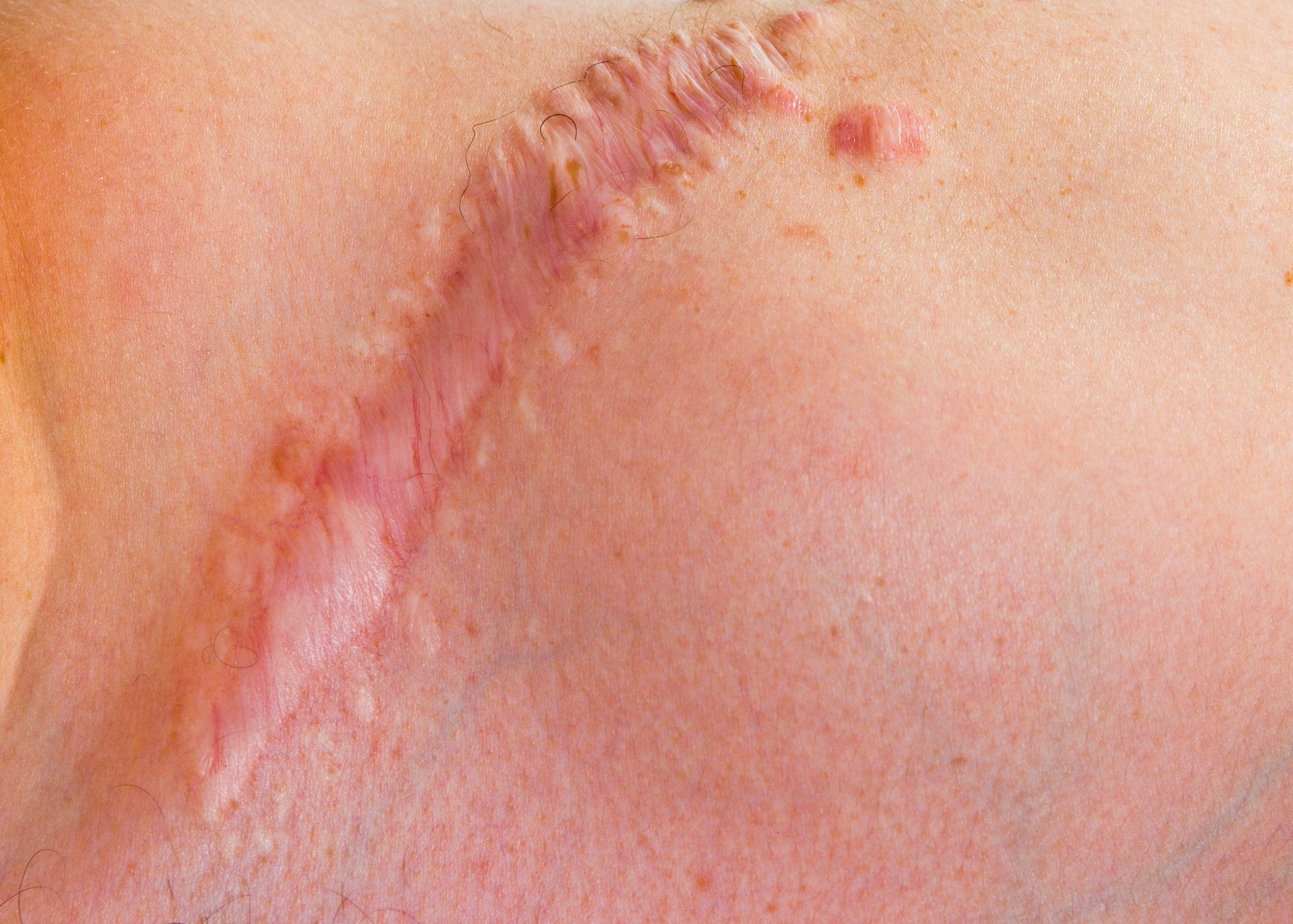 Wound/Scar Treatment