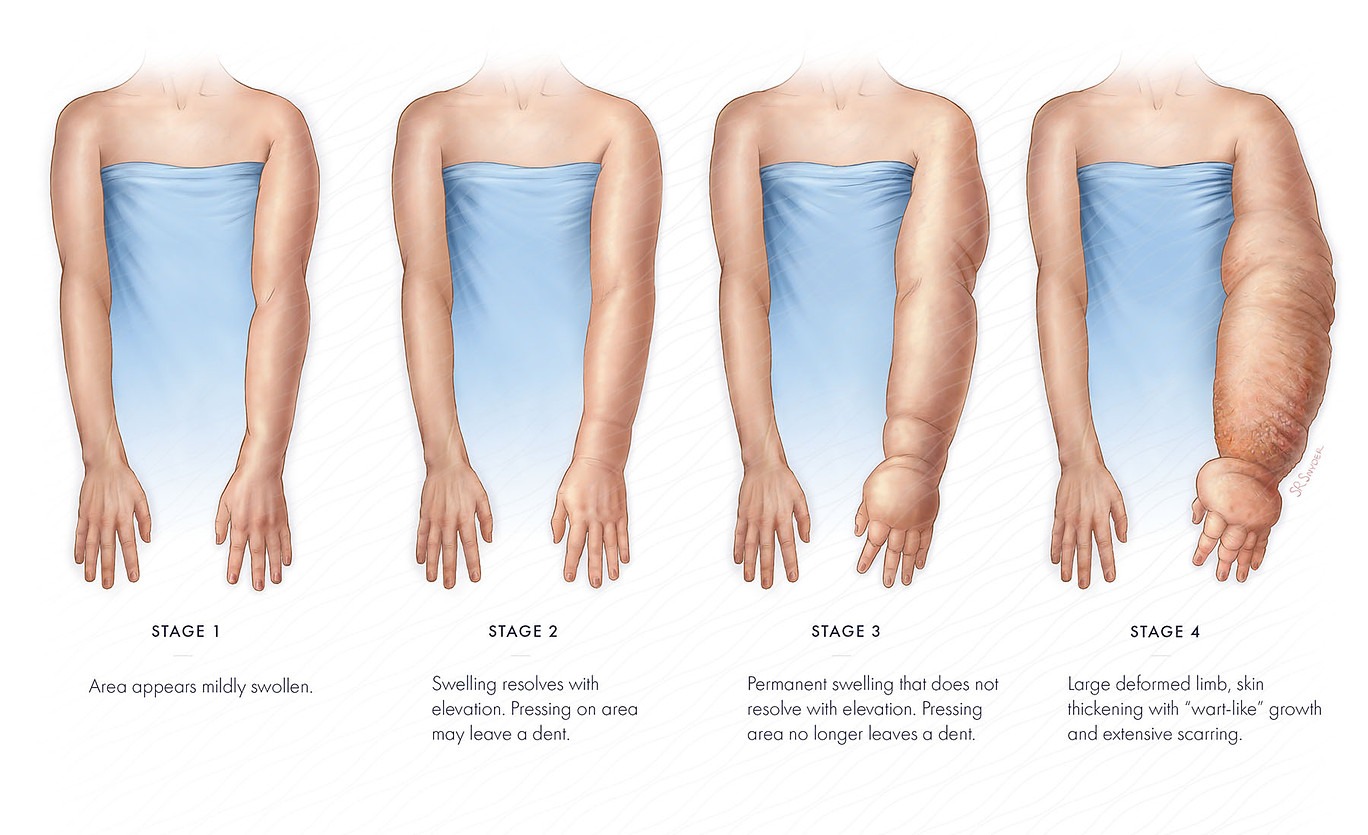 four stages of lymphoedema progression in the arm