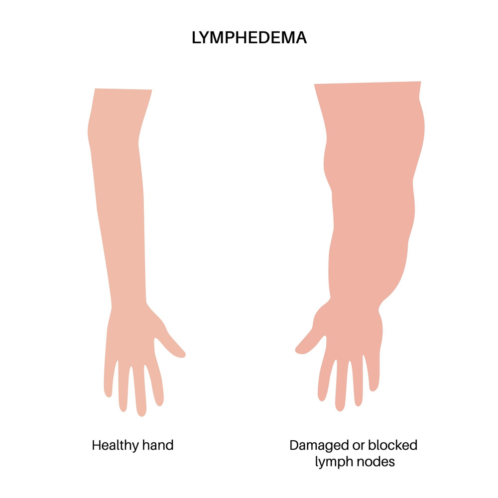 Signs Your Lymphatic System May Be Blocked