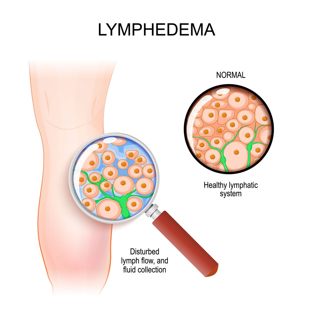 What is Lymphoedema?