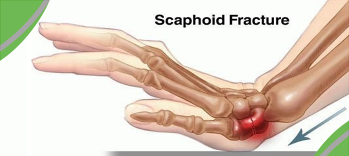 Scaphoid Fracture