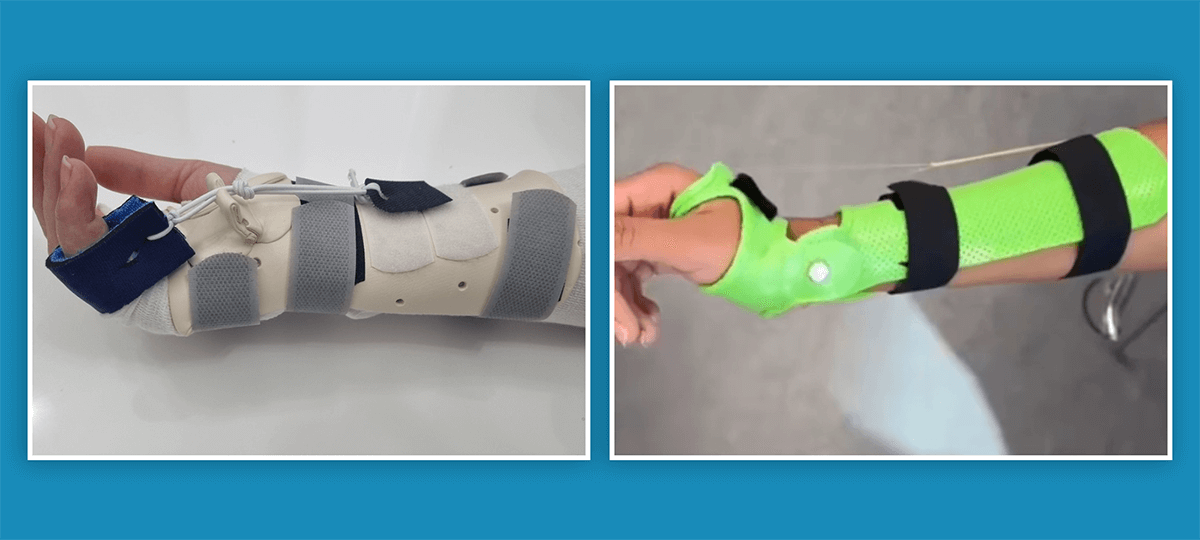 Dynamic Splints