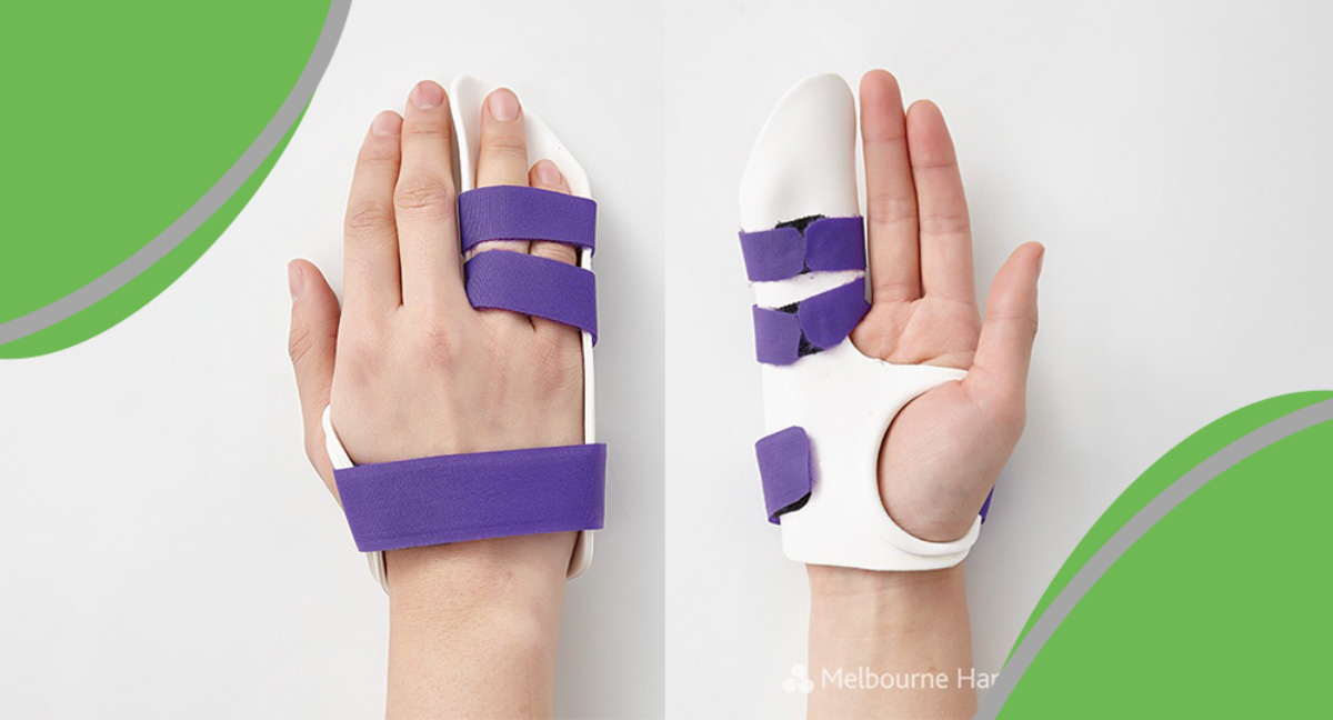Dupuytren’s Contracture and Surgical